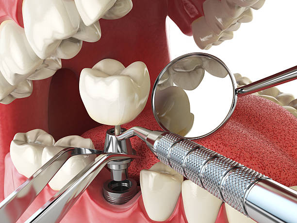 Best Knocked-Out Tooth (Avulsed Tooth) Treatment in London, KY